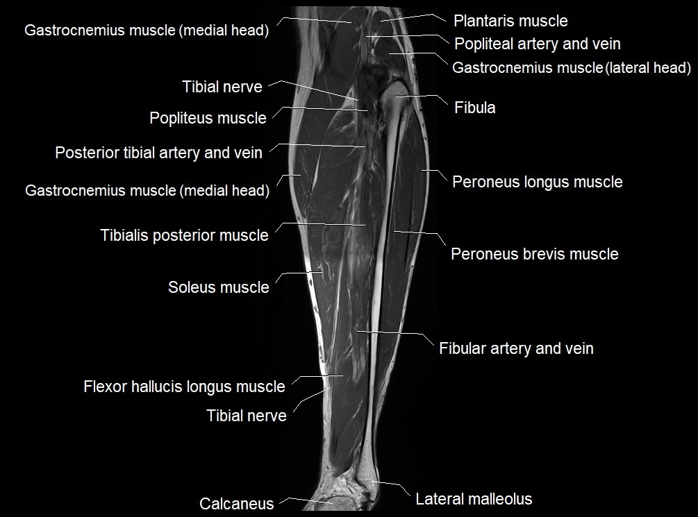 MRI 3T leg (tibia & fibula) labelled coronal cross sectional anatomy image 20.webp